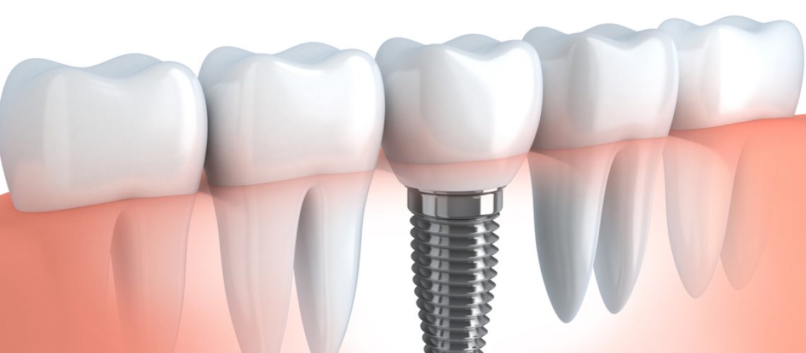 Tooth human implant (done in 3d graphics)