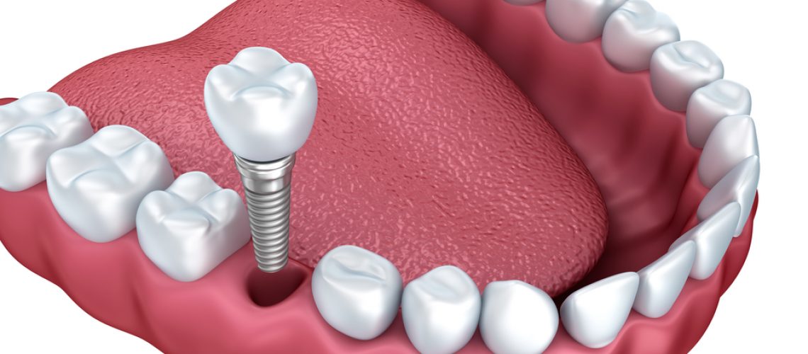 3d lower teeth and dental implant isolated on white